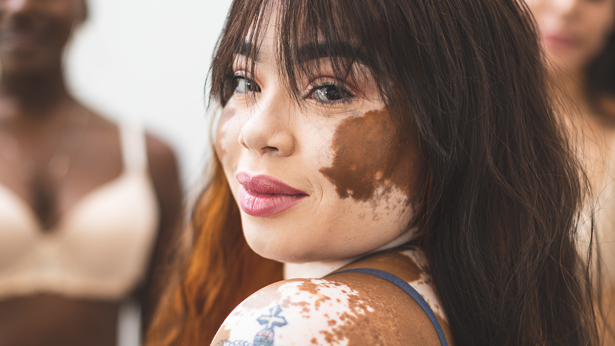 Benoquin Cream for use skin care Vitiligo tips